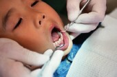 Caries en niños