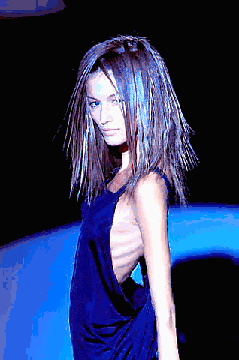 Anorexia Nerviosa