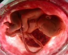 Preeclampsia