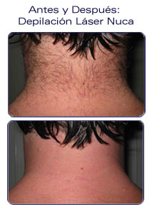 depilacion laser